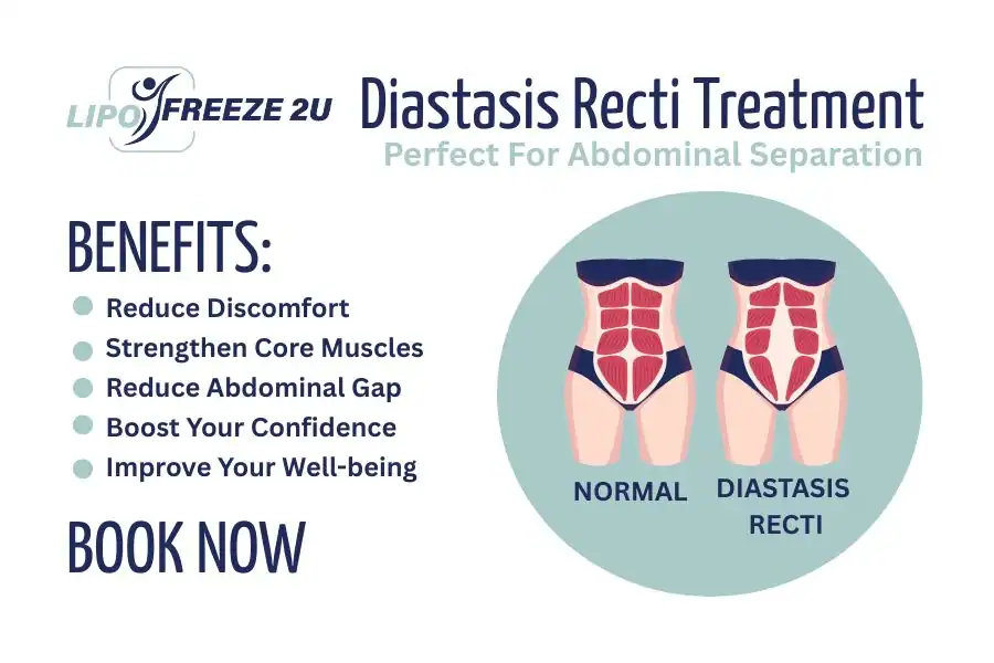 Benefits of body toning treatment Warwick for Diastasis recti