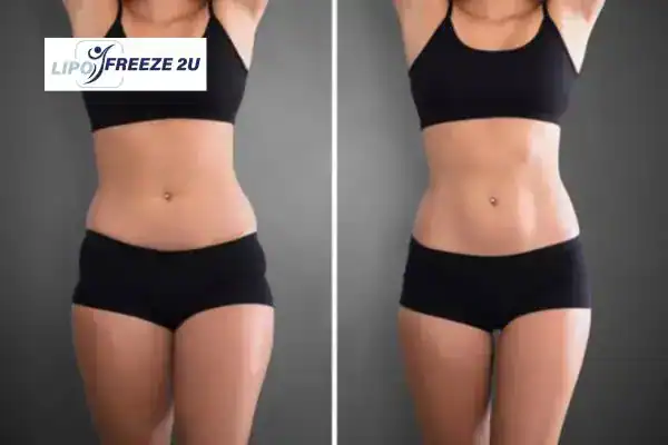 How Can LIPO FREEZE 2U Support Your Post-Pregnancy Body Recovery Warwick?