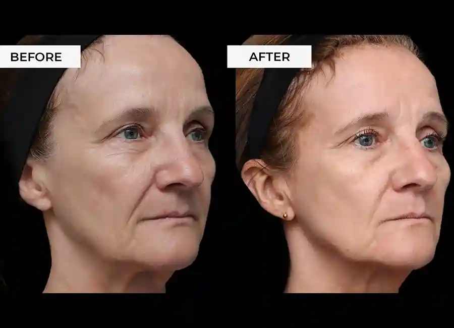 How Many RF Microneedling Sessions Will You Need to See a Difference Warwick?