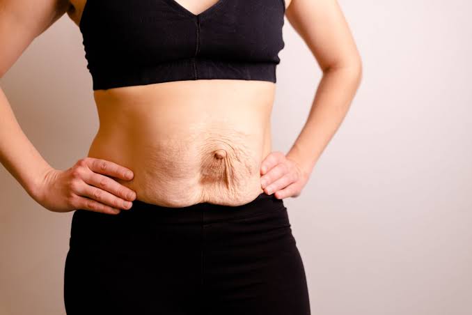 Is Surgery Really the Only Way to Repair Diastasis Recti Warwick?