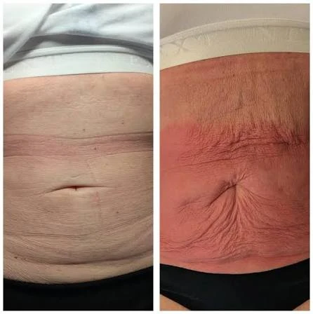How Does RF Microneedling Improve Crepey, Thin and Uneven Skin Texture Warwick?
