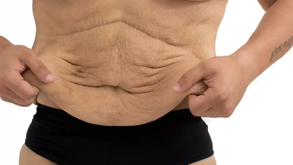 RF Microneedling for Loose Skin: How Can It Help Tighten and Reshape the Skin Warwick?